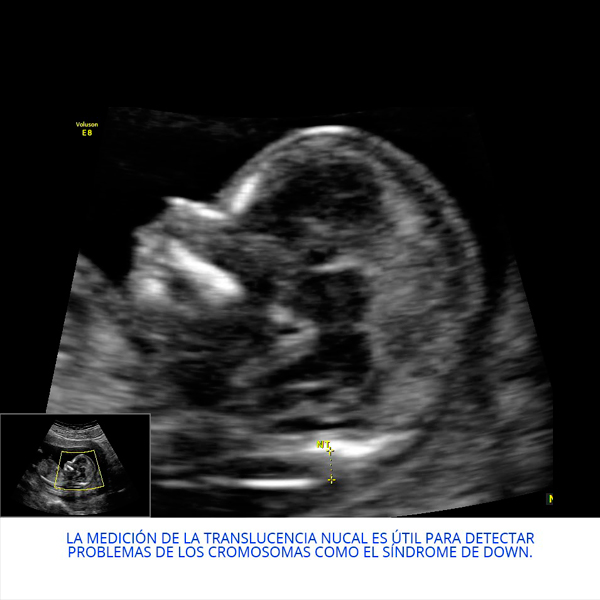 Translucenia nucal